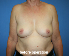 plastic-surgery-breast-augmentation